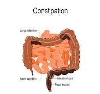 constipation